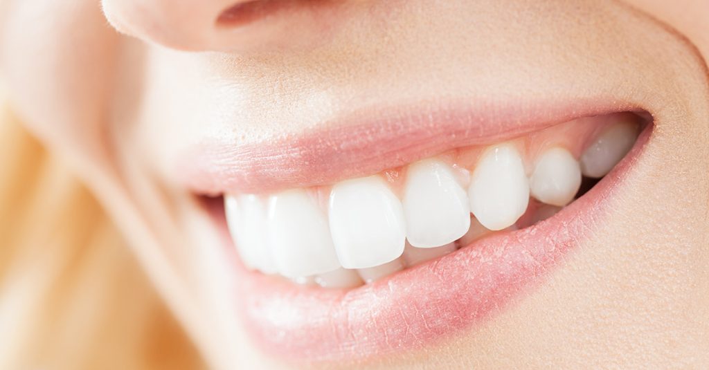 A close-up of dental veneers