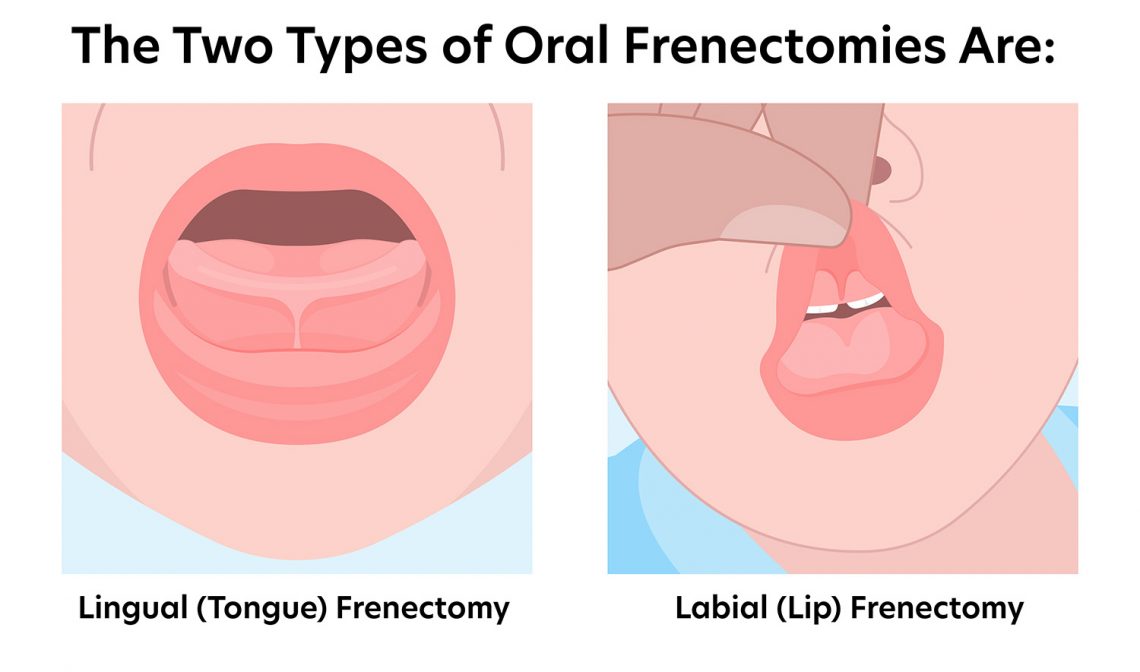 frenectomy in Winchester VA