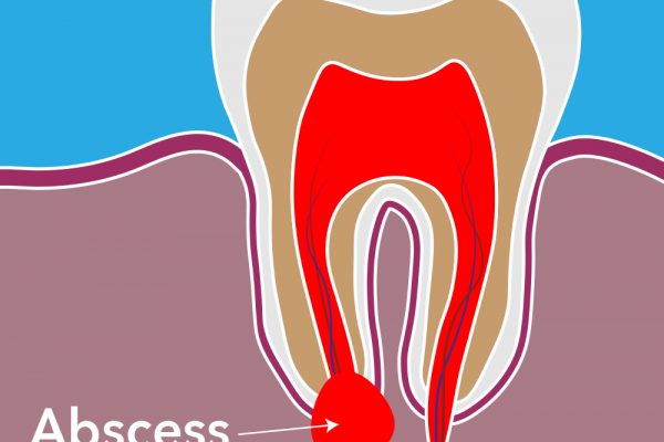 abscess treatment
